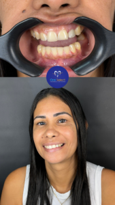 Implantes Dentários